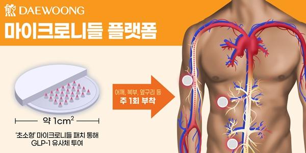 대웅제약 GLP-1 비만치료제 '마이크로 니들'로 개발, 2028년 상용화 목표