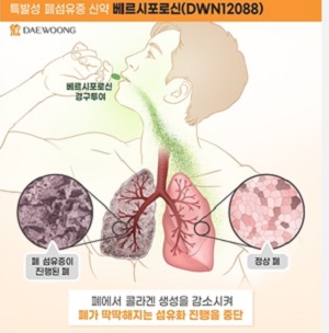 대웅제약 특발성 폐섬유증 치료제 임상2상 순항, 이창재 "안전성 입증 이정표"